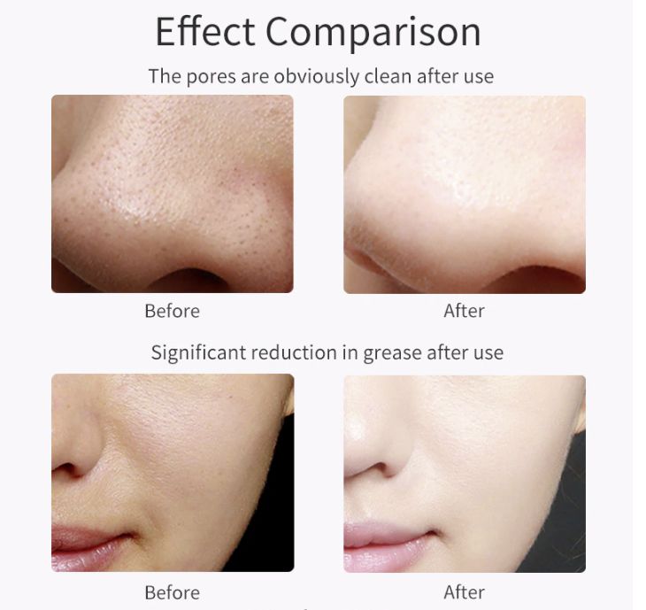 Results of ultrasonic facial cleansing